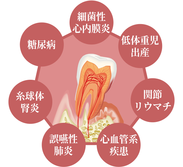 歯周病（歯槽膿漏）はとても怖い病気です