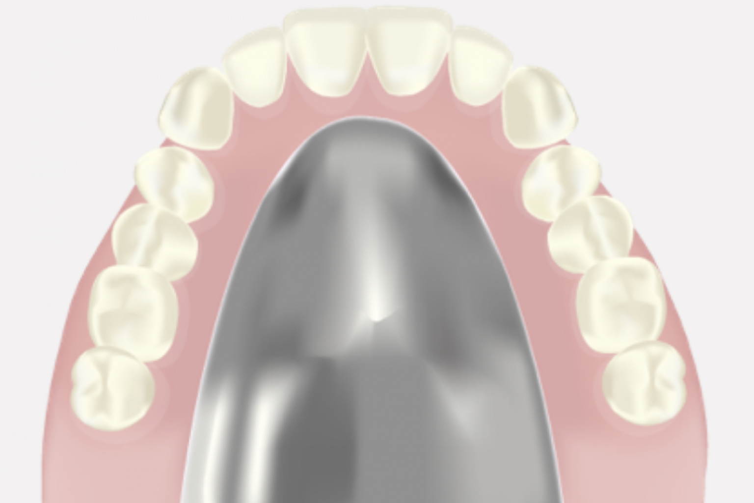 金属床入れ歯のイメージ