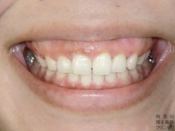 原因に応じてガミースマイルの治療法を選定