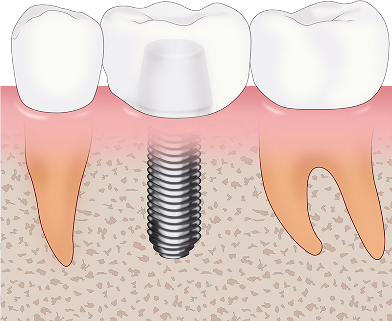 「もう一度しっかり噛みたい」を叶える先進治療