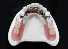 患者様お一人おひとりのお口に合った義歯を提供することに力を入れています