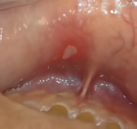 口内炎がなかなか治らない場合は、歯科医院で診てもらうことをお勧めします