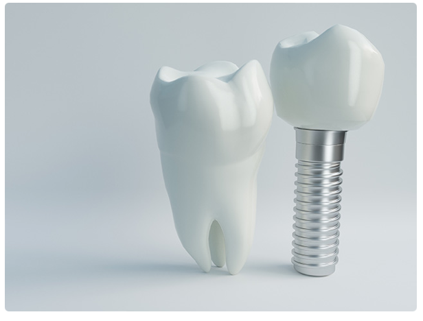 インプラント治療について気になる方はご相談ください