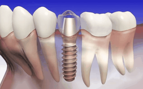 CTによる三次元画像で骨の状態を丁寧に把握