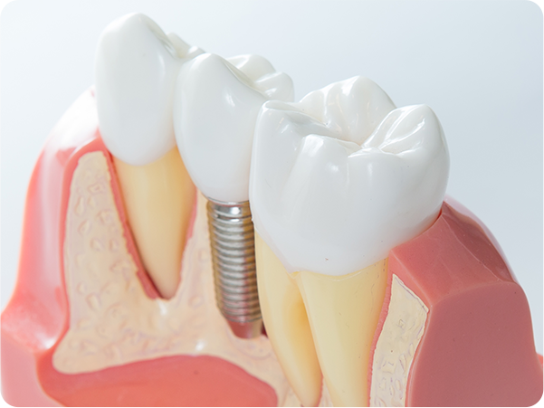 失った歯の機能を取り戻して見た目や快適さを向上させる治療法