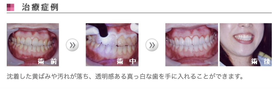 自然な白さを追求したい方に最適な治療を提供しています