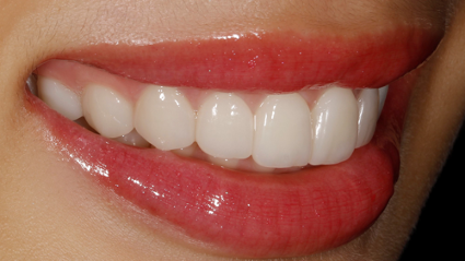 世界新基準の歯にやさしい審美美容治療法、スーパーエナメル