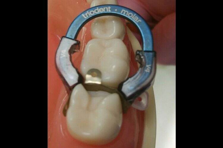 むし歯の大きさや状態に応じて詰め物・かぶせ物の治療方法を使い分けています