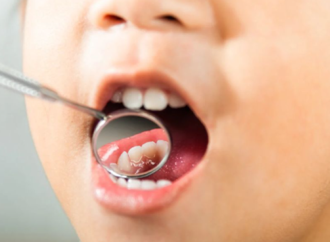 健康な歯を長く維持するために