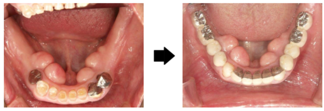 インプラント咬合の改善症例