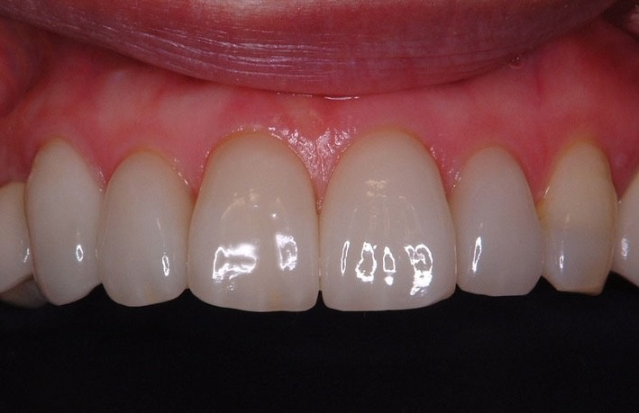 見た目だけでなく、噛み心地にもこだわった自然な仕上がり