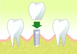 インプラント治療で、自然な噛み心地と美しい笑顔を再び取り戻しましょう