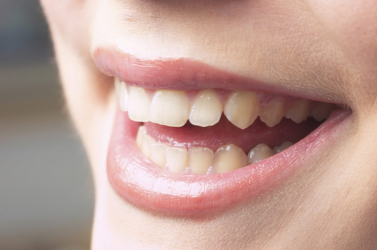 歯にやさしいホワイトニングです