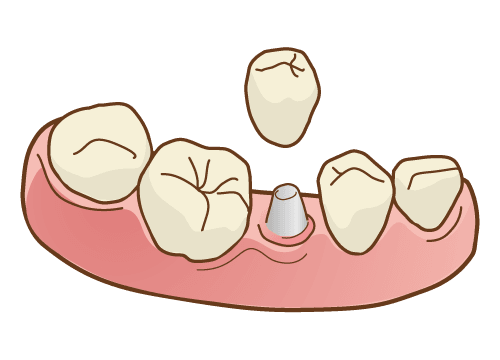 インプラント治療において精密な診査・診断を行い、安全かつ確実な治療を提供しています
