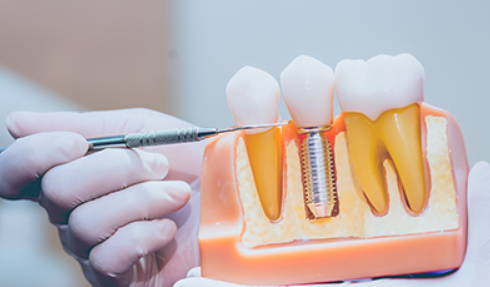 安心安全なインプラント治療をご提案いたします