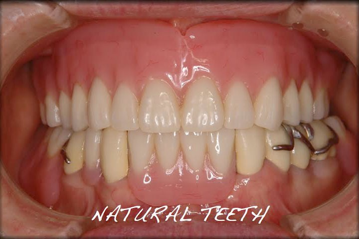 最高峰の義歯を提案しています