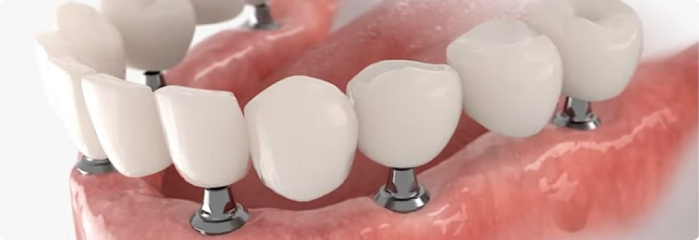 オールオン4インプラント治療も可能