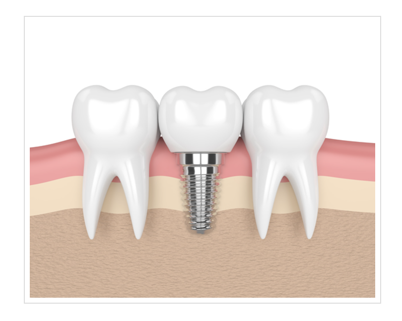 失われた歯の機能や見た目を取り戻すお手伝いを行っています