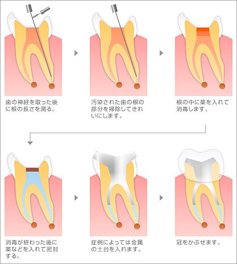 根管治療の治療法