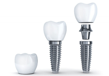 むし歯や歯周病、外傷などで失った歯の機能と見た目を回復させるインプラント治療に対応しています