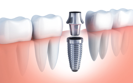 術後の腫れや痛みも最小限に抑えられるため、患者様への負担が少なくて済みます。