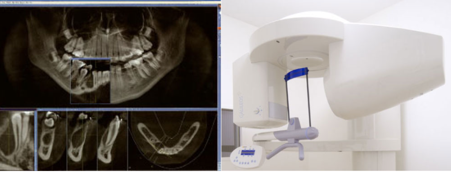 最新の技術と機器で可能になる義歯