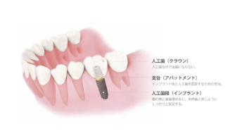 失った歯の機能と美しさを取り戻すサポートをしています。