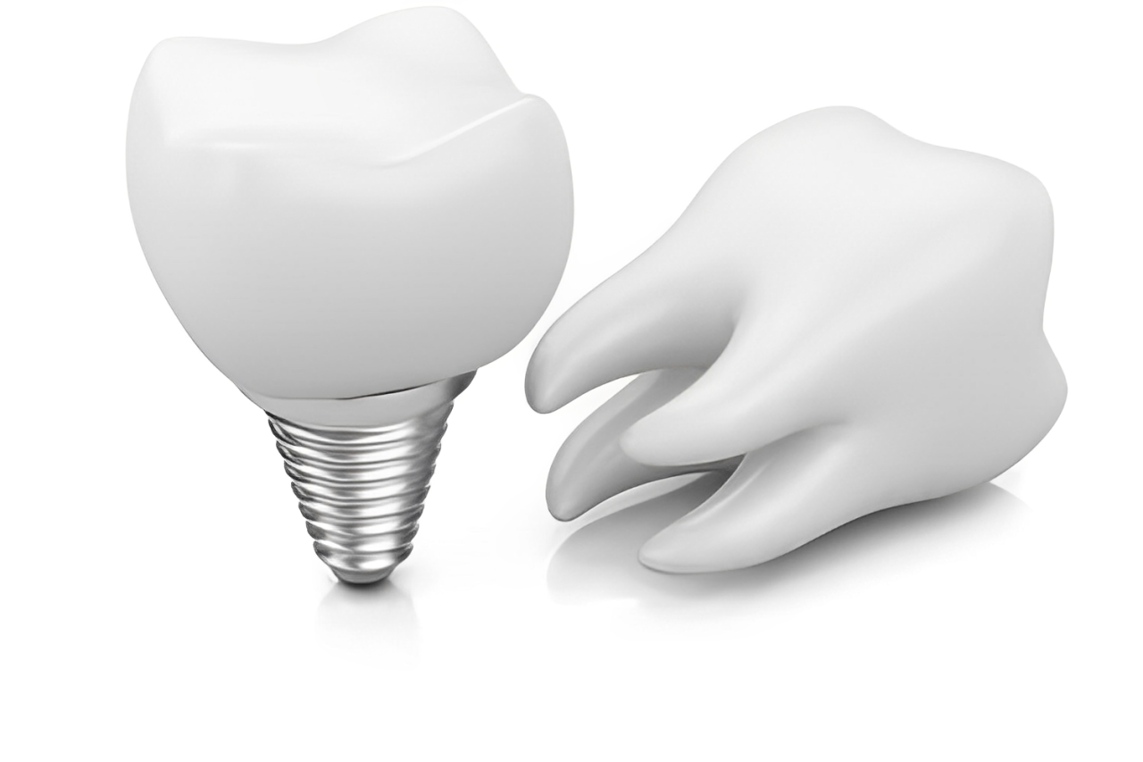 インプラントで歯を美しく