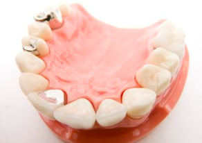 虫歯部分をしっかり取り除き、かぶせ物をする部分もできるだけ丁寧に削ります。