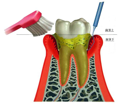 セルフケアと歯科クリニックでのケア、両方が必要です