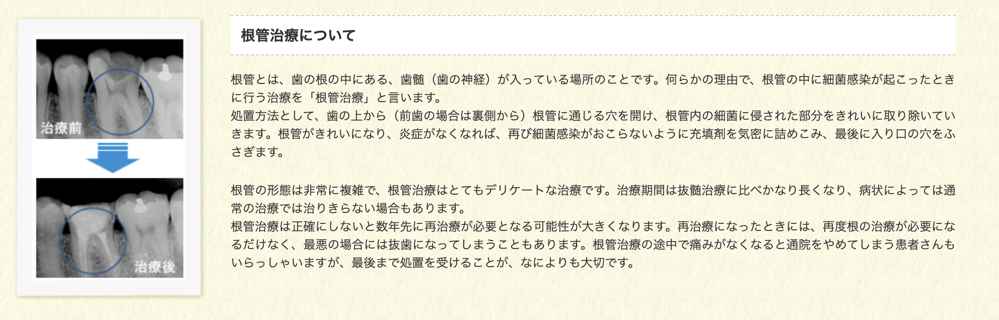 根管治療は、歯の保存を目指す上で非常に重要な治療です