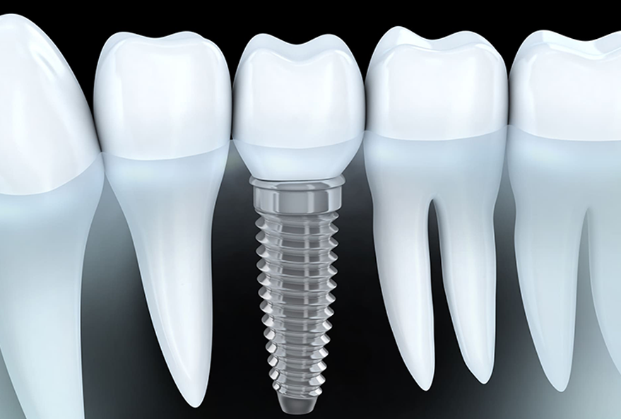 インプラント治療