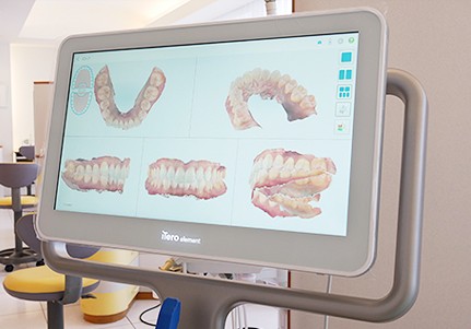 iTeroという口腔内スキャナーにより歯型を採取しています