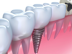違和感のない人工歯で快適に