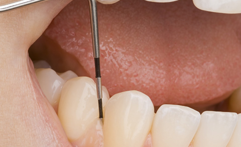 予防と早期対応が鍵の歯周病対策