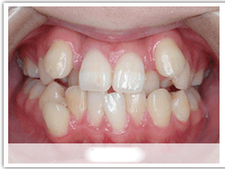 突出感といった不自然さを口元に残しません