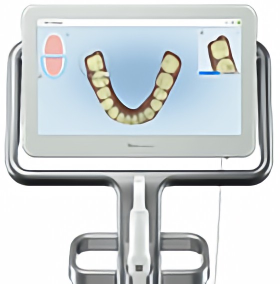 3Dスキャニング「iTero」