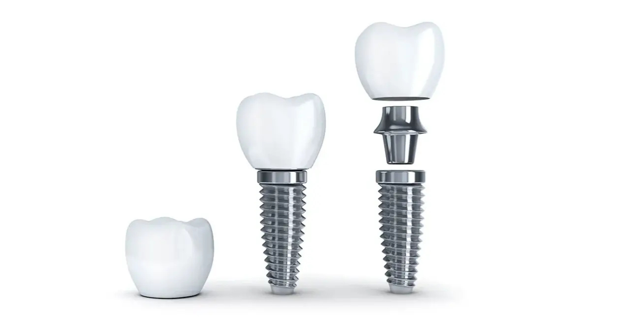インプラント治療はお任せください。