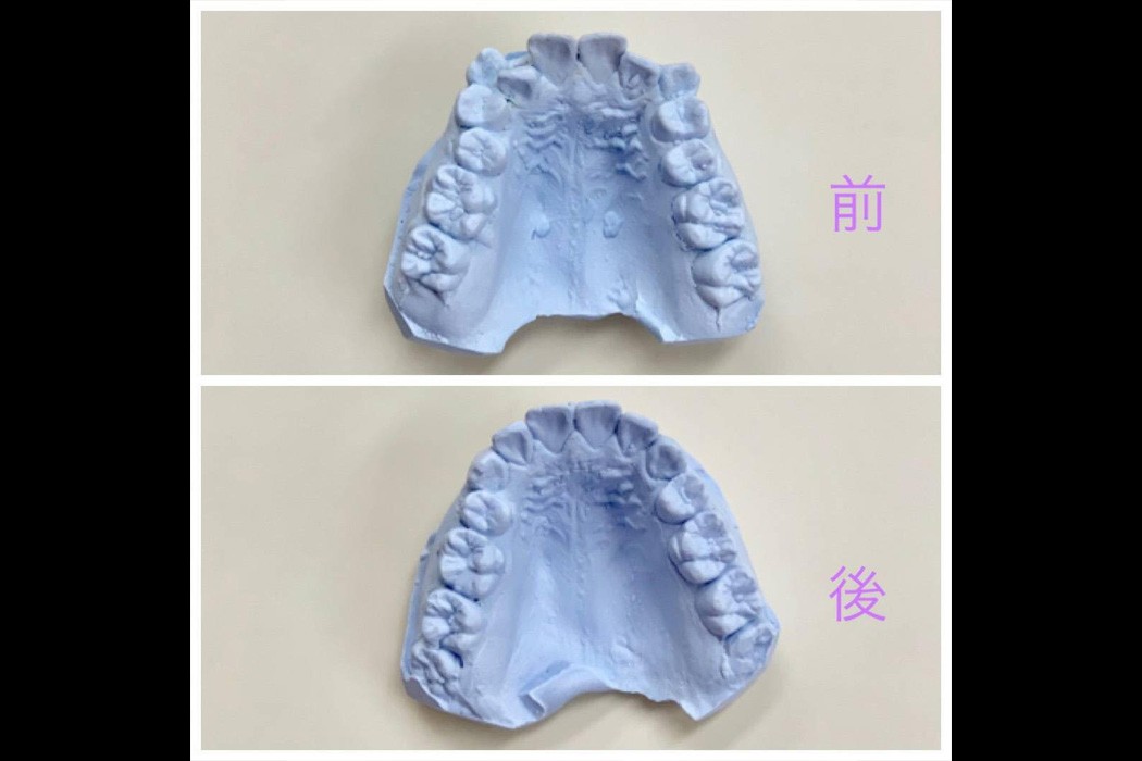 約2年ほどで完治した中学生の前歯矯正です