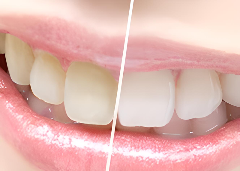 天然歯に近い見た目と質感を追求するセレックとホワイトニング