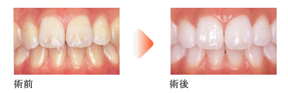 歯の見た目をきれいにしましょう