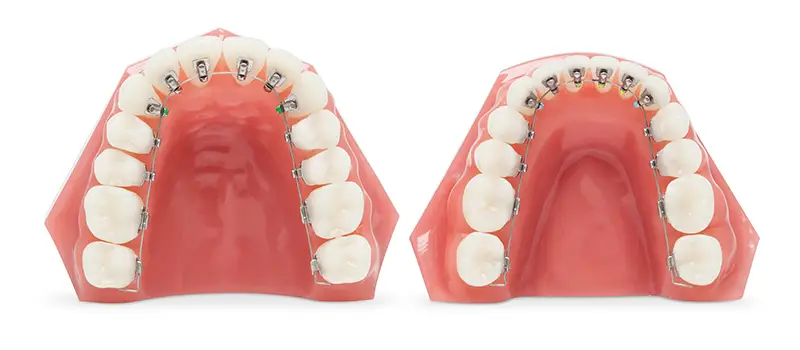 歯の裏側に装置を付けるため、外からはほぼ見えない矯正治療です