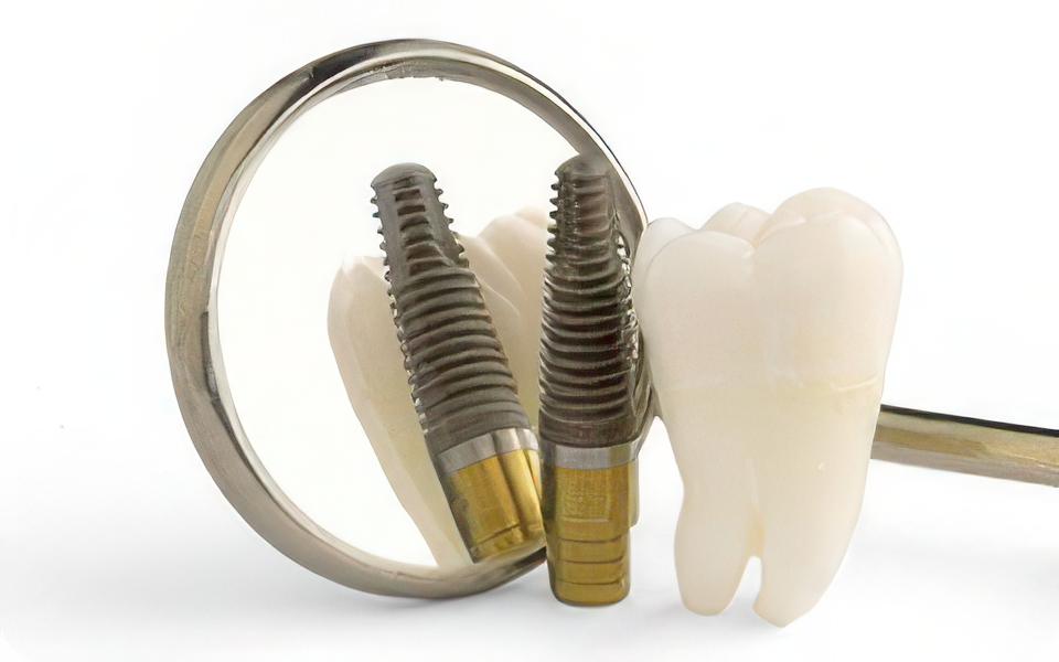 安心のインプラント治療を提供しています