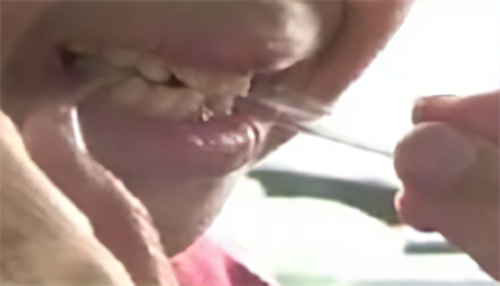 かみ合わせ改善治療