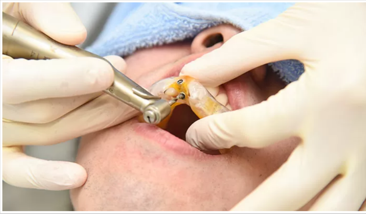 最先端の機器を使いより安全、安心にインプラント治療を行なっております。