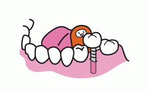 精密と安心の融合！いしだ駅前歯科が誇るインプラント治療の真髄