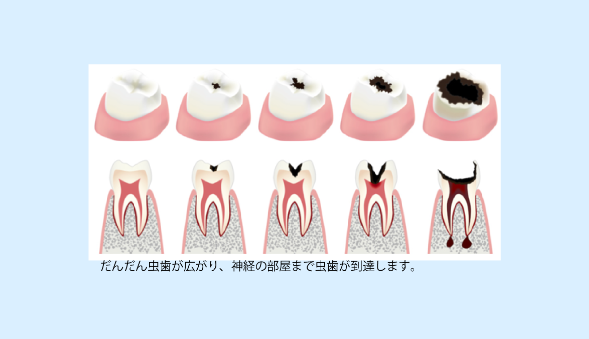 なるべく削らず、神経も取らずに済む“低侵襲”な虫歯治療