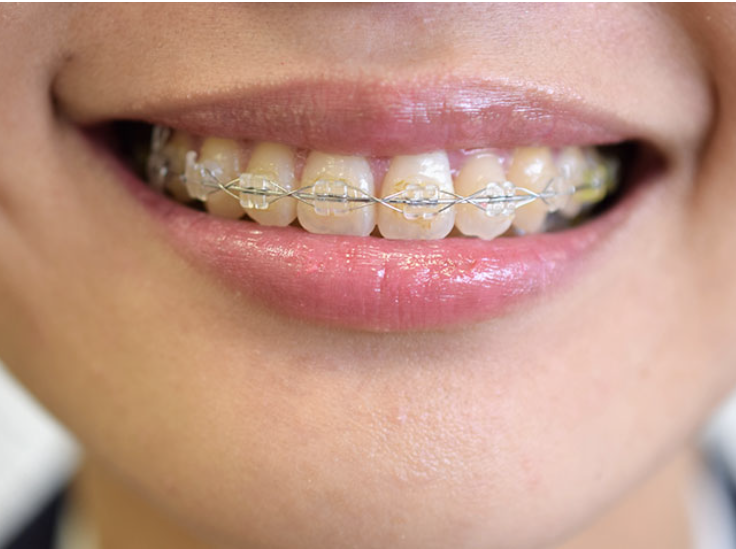 矯正治療の様子