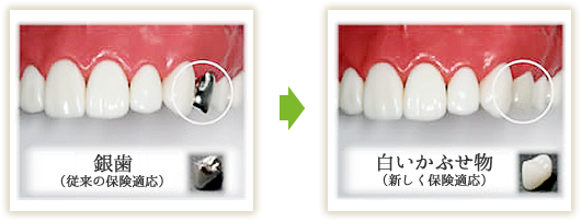 虫歯治療から抜歯まで、歯を大切にした治療を行います：そめや歯科の一般歯科