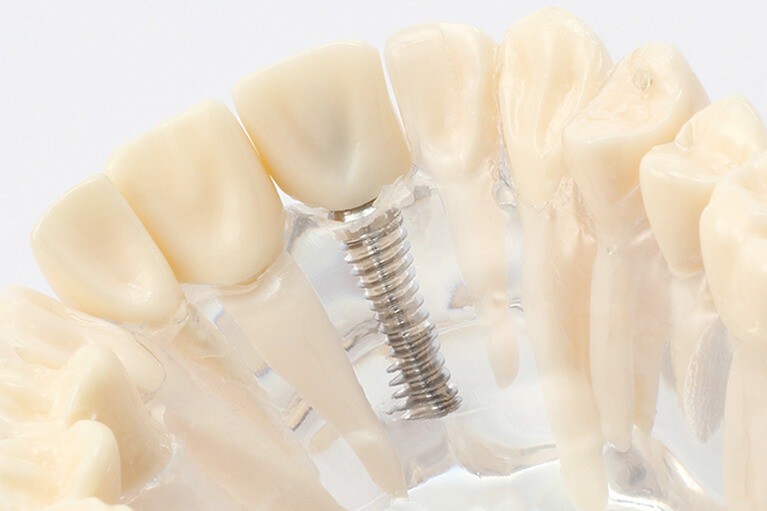 天然歯に近い噛み心地と自然な外観が得られます。